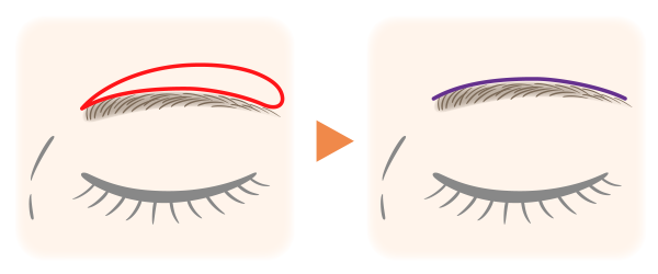 眉毛上皮膚切除の図解イラスト。切開部と縫合部について