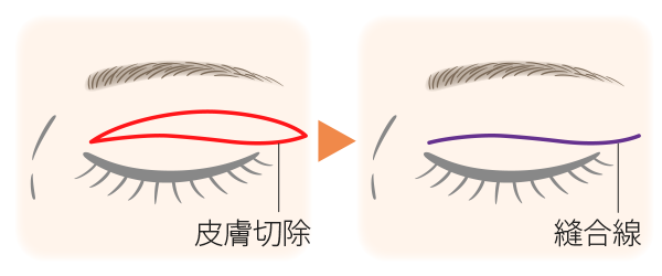 上眼瞼皮膚切除の図解イラスト。切開部と縫合部について