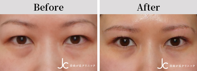 上まぶたのたるみとりの症例写真