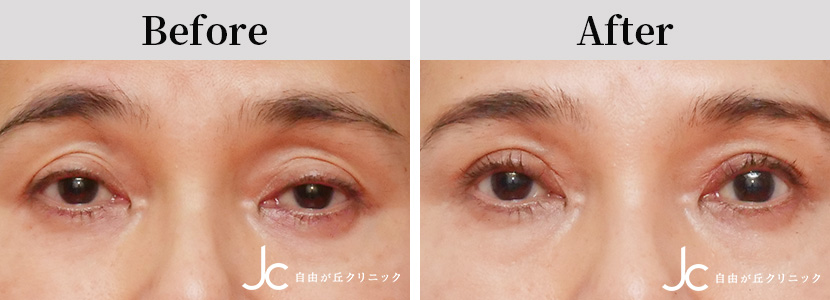 眼瞼下垂の症例写真
