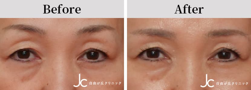 上まぶたのたるみとりの症例写真