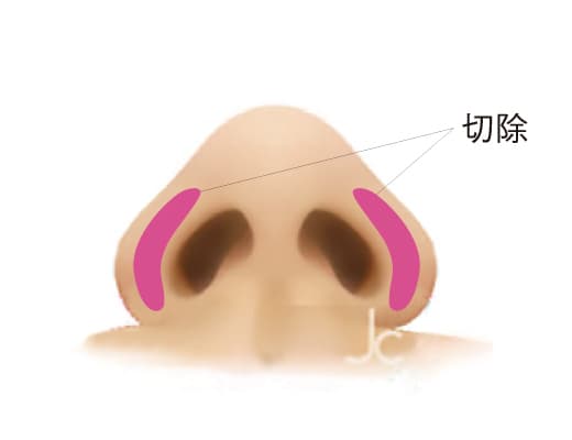 小鼻縮小術のイメージ画像