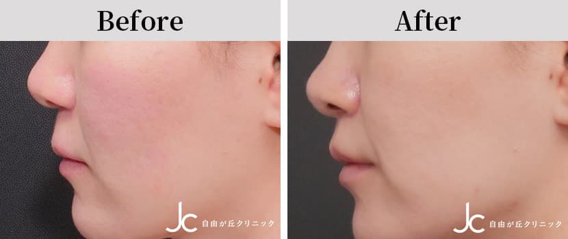 リップリフトの症例写真