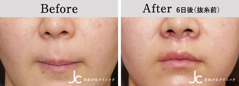 リップリフトの症例写真