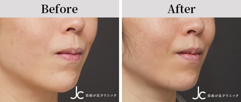 リップリフトの症例写真