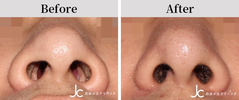 小鼻縮小術の症例写真