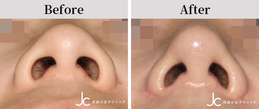 小鼻縮小術の症例写真