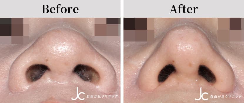 小鼻縮小術の症例写真