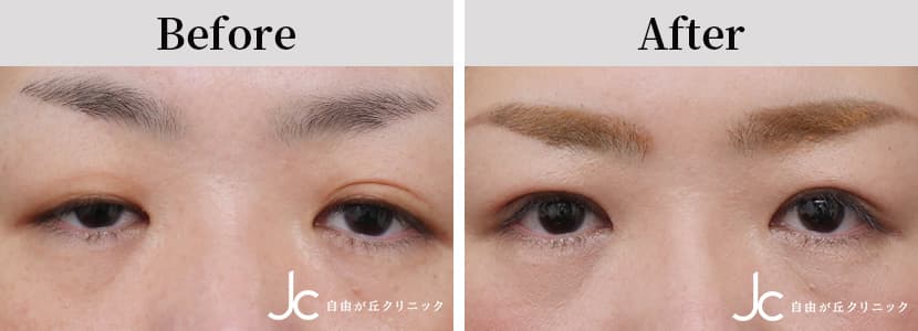 眼瞼下垂の症例写真