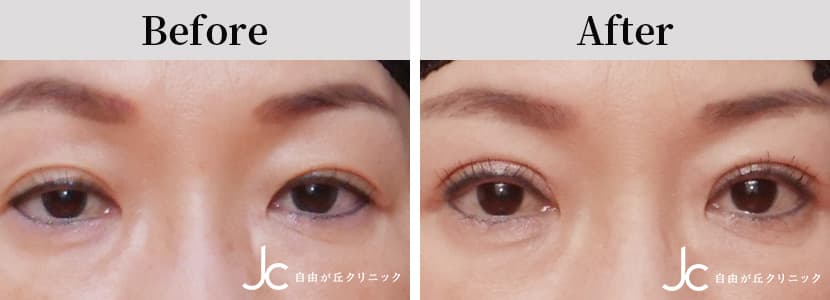 眼瞼下垂の症例写真
