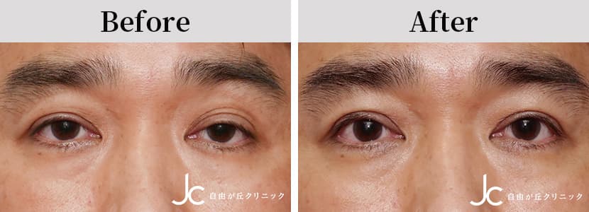 眼瞼下垂の症例写真
