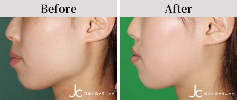 エラ縮小術の症例写真