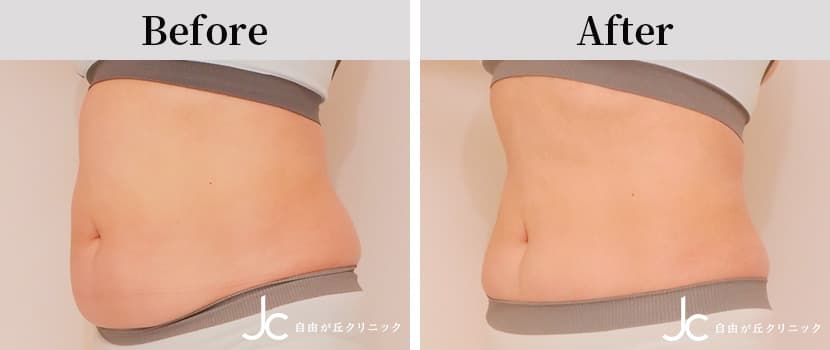 クールスカルプティングの症例写真