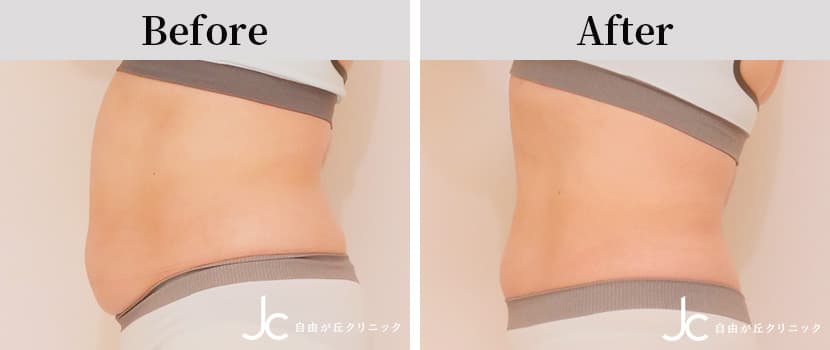 クールスカルプティングの症例写真
