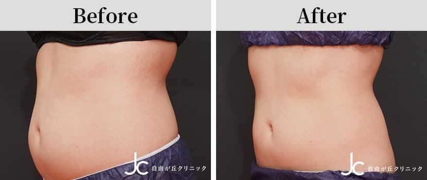 クールスカルプティングの症例写真