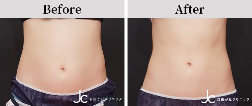 クールスカルプティングの症例写真