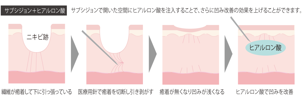 ニキビ跡治療『サブシジョン』の治療例