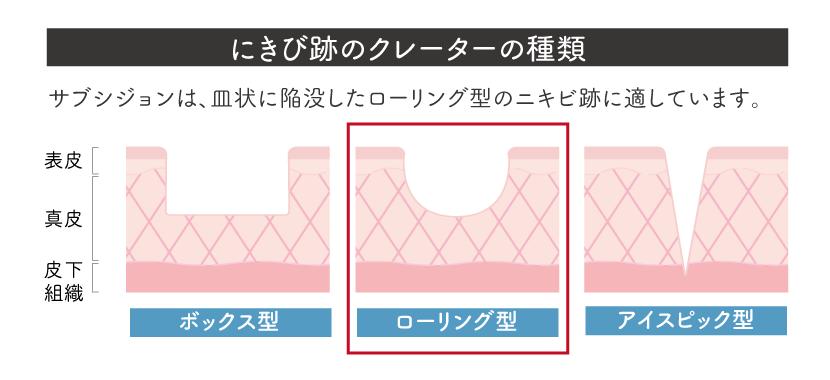 にきび跡のクレーターの種類