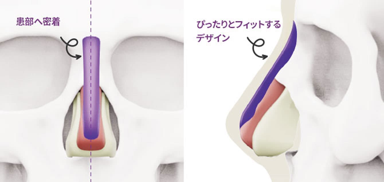 プロテーゼ
