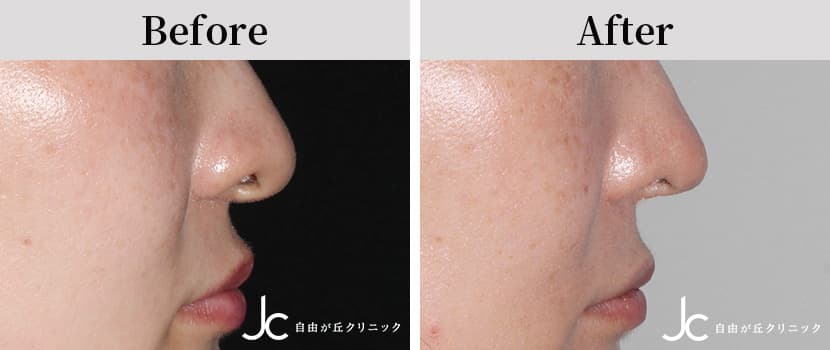 口唇裂術後の修正手術の症例写真