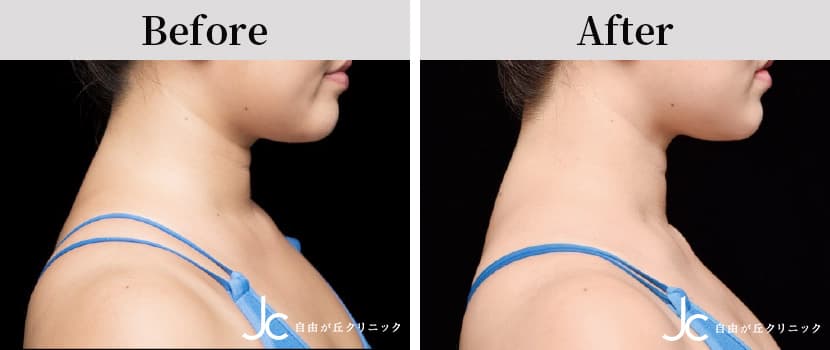 クールスカルプティングの症例写真