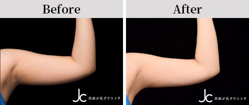 クールスカルプティングの症例写真