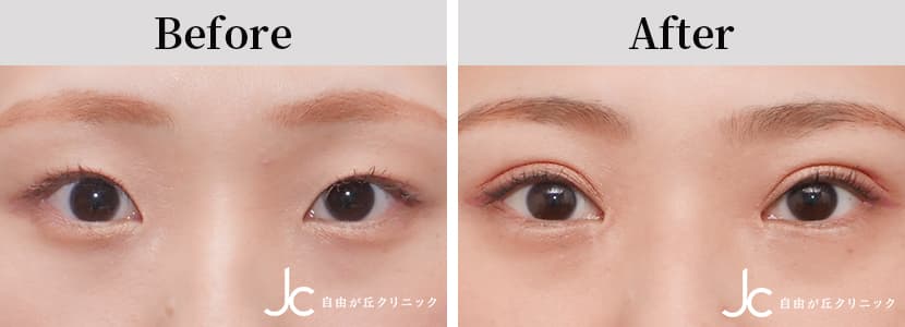 二重（切開）の症例写真