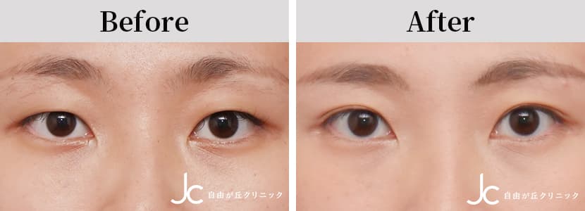 二重（埋没）の症例写真