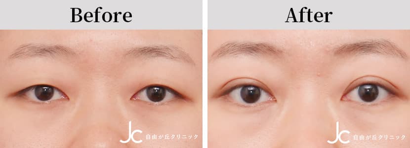 二重（埋没）の症例写真