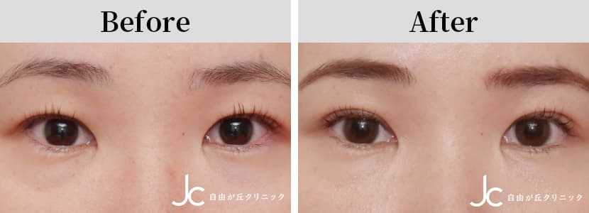 二重（埋没）の症例写真