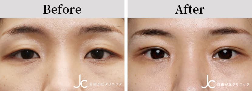 二重（切開）の症例写真