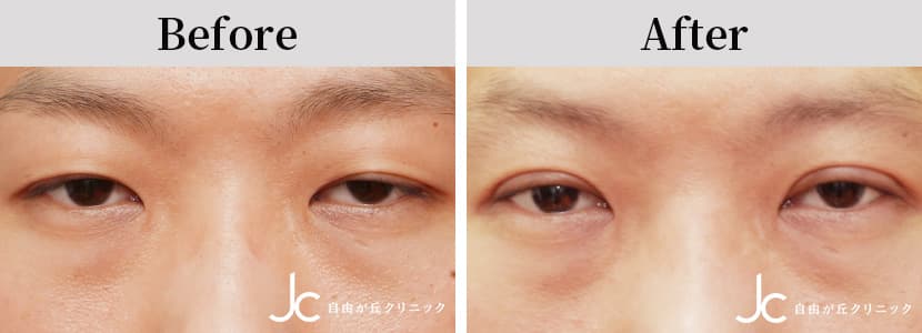 二重（切開）の症例写真