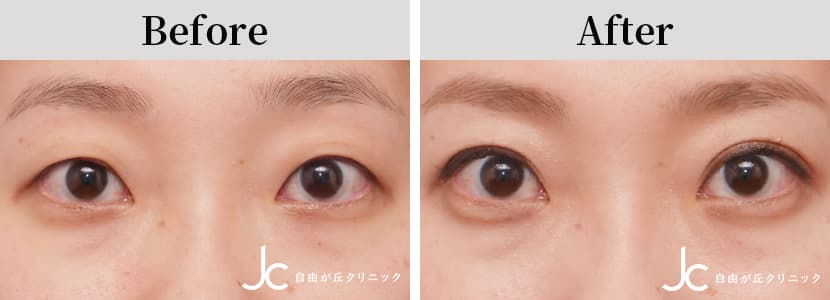 二重（切開）の症例写真