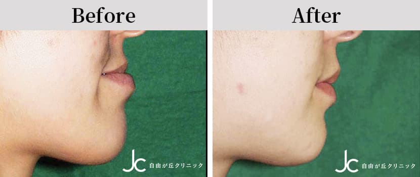 下顎手術の症例写真