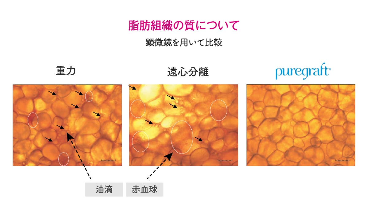 濾過方法による脂肪組織の質