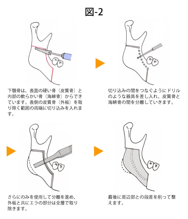 スプリッティングオステクトミーの図解2