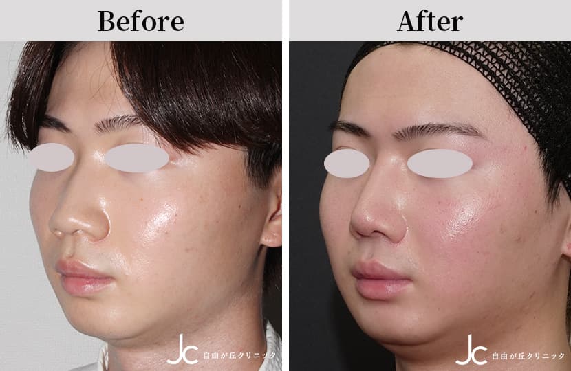 鼻の手術の症例写真