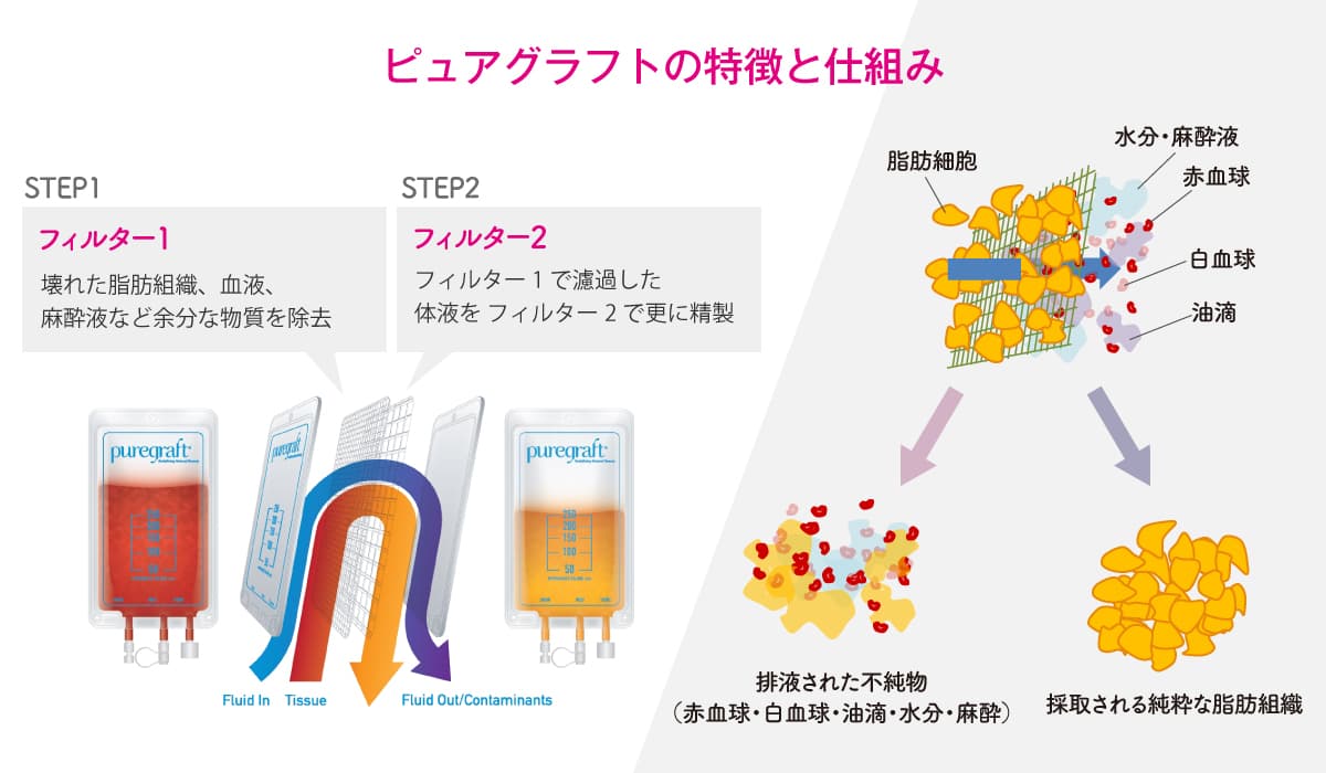 ピュアグラフトの特徴と仕組み