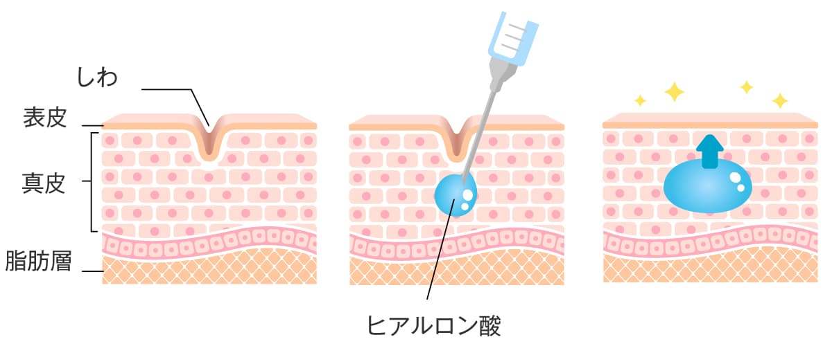 ヒアルロン酸注射の作用と仕組みのイラスト