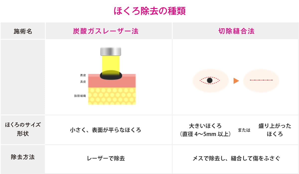 炭酸ガスレーザー法と切除切除縫合法の比較図