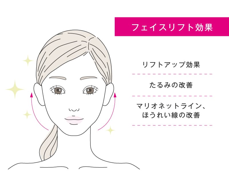 フェイスリフト効果のイラスト。リフトアップ効果、たるみやほうれい線の改善など