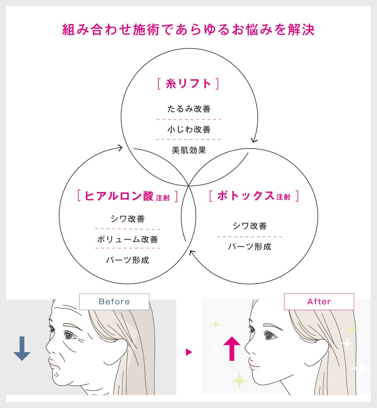 糸リフト・ヒアルロン酸・ボトックスの組み合わせ施術の解説イラスト