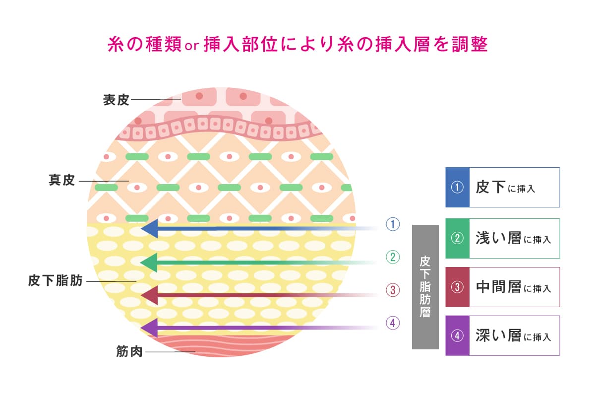 糸の種類、挿入部位によって糸の挿入層を調整していることを解説するイラスト