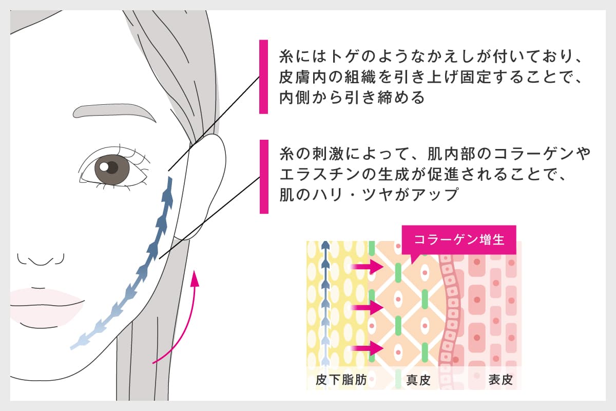 糸リフトの効果の解説イラスト