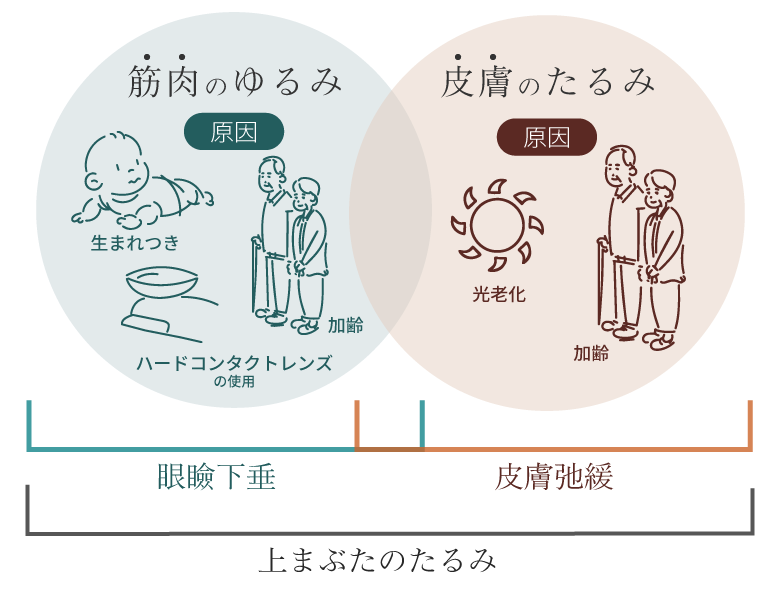 上まぶたのたるみの図解イラスト。眼瞼下垂と皮膚弛緩の関係図。