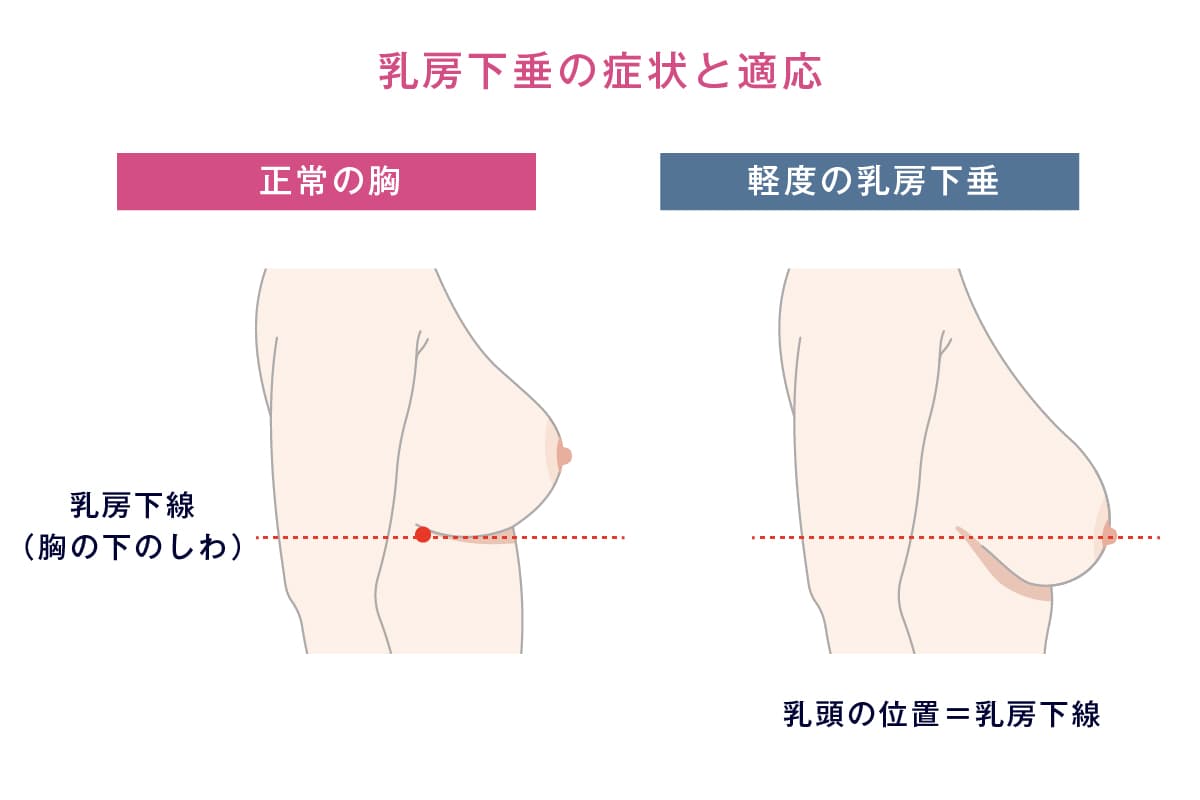 乳房下垂の症状と適応