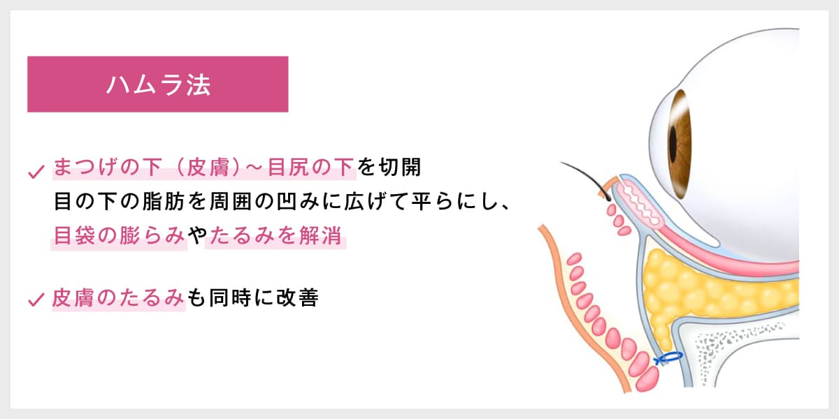 ハムラ法