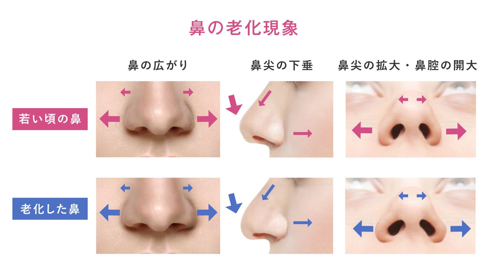 若い頃の鼻と、老化した鼻の変化についての解説画像。鼻は横に広がり、鼻尖は下垂し、鼻尖拡大・鼻腔の開大を認める