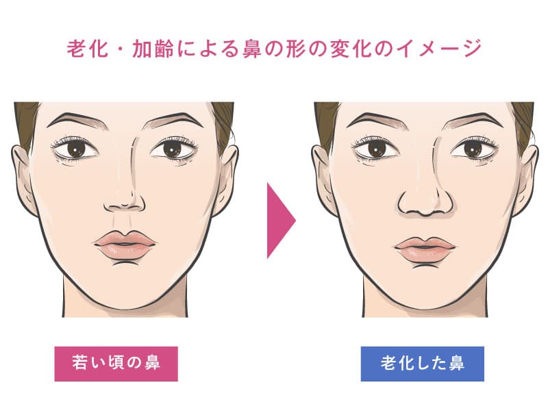 若い頃の女性の鼻と、老化した女性の鼻の解説イラスト。老化した女性の鼻は大きく、団小鼻