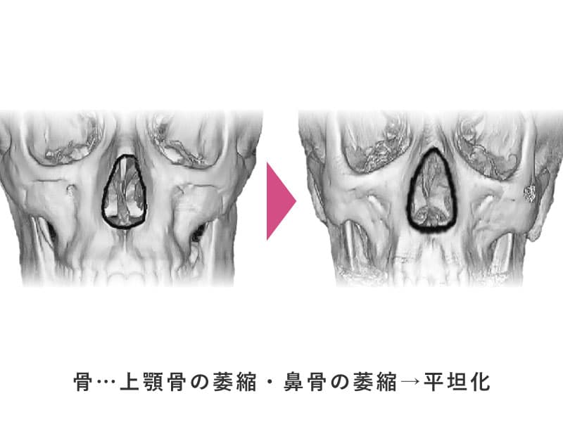 上顎骨と鼻骨の萎縮のイメージ画像